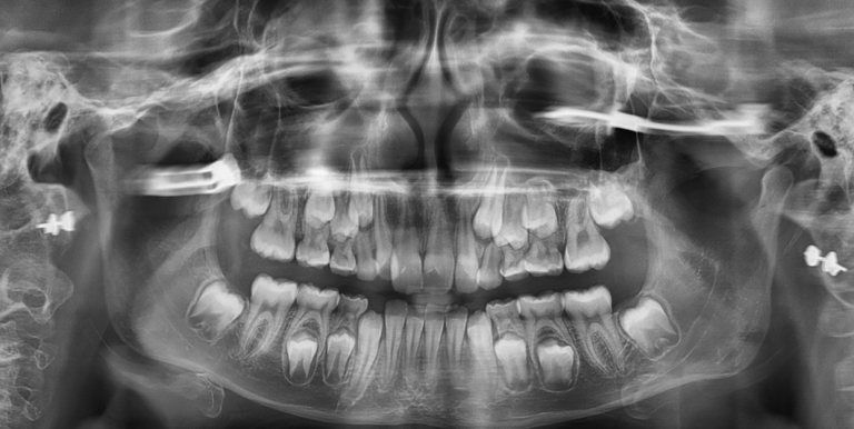 How Can Digital X-Rays Enhance Your Orthodontic Treatment